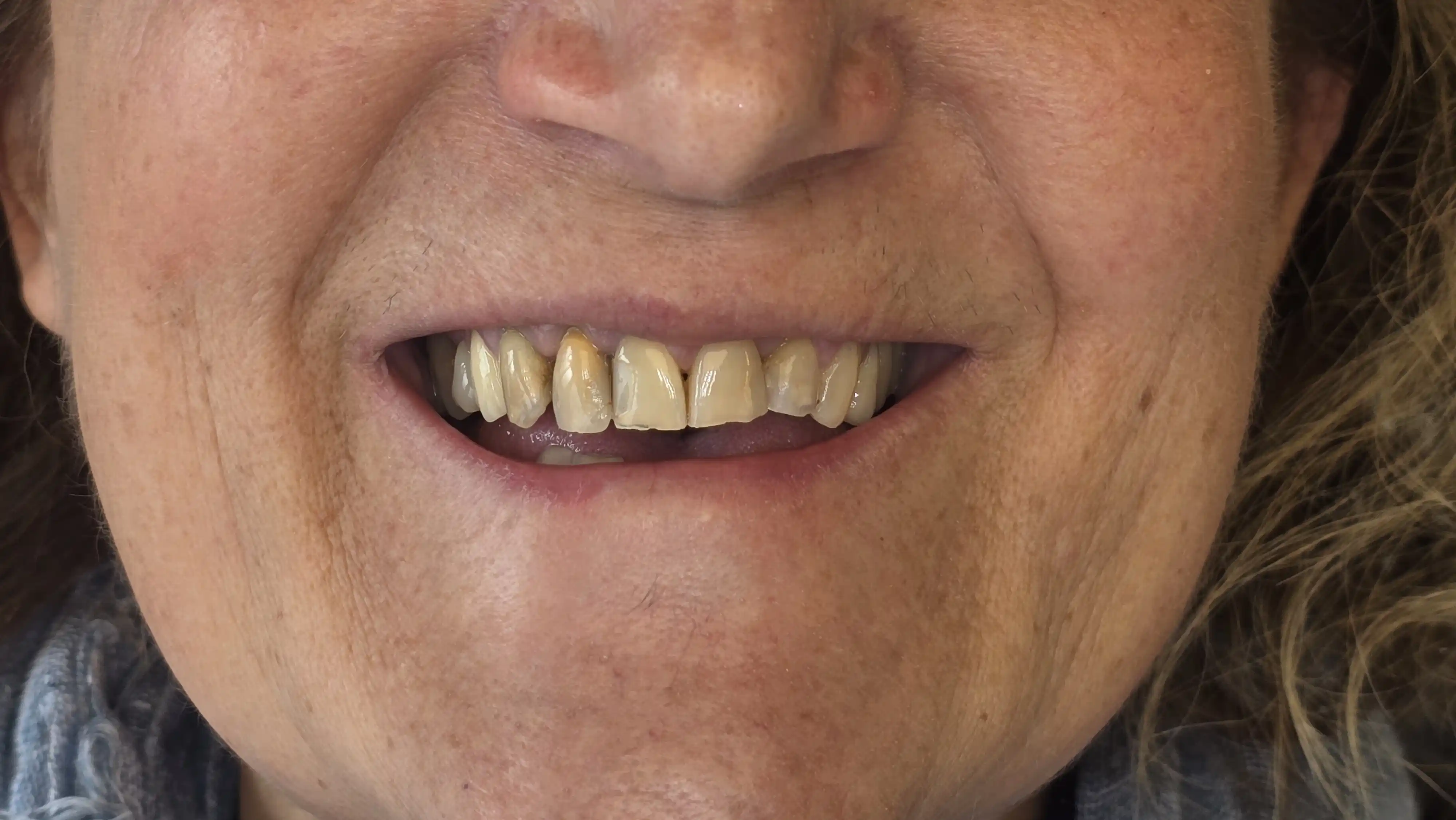 Before: Zirconia crowns